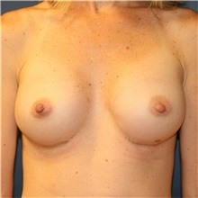 Breast Augmentation After Photo by Steve Laverson, MD, FACS; Rancho Santa Fe, CA - Case 37474