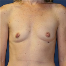 Breast Augmentation Before Photo by Steve Laverson, MD, FACS; Rancho Santa Fe, CA - Case 37474