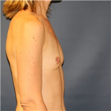 Breast Augmentation Before Photo by Steve Laverson, MD, FACS; Rancho Santa Fe, CA - Case 37474