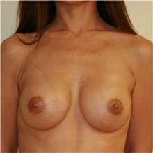 Breast Augmentation After Photo by Steve Laverson, MD, FACS; Rancho Santa Fe, CA - Case 37475