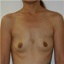 Breast Augmentation Before Photo by Steve Laverson, MD, FACS; Rancho Santa Fe, CA - Case 37475