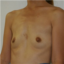 Breast Augmentation Before Photo by Steve Laverson, MD, FACS; Rancho Santa Fe, CA - Case 37475