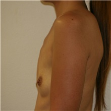 Breast Augmentation Before Photo by Steve Laverson, MD, FACS; Rancho Santa Fe, CA - Case 37475