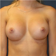 Breast Augmentation After Photo by Steve Laverson, MD, FACS; Rancho Santa Fe, CA - Case 37476