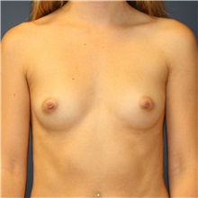 Breast Augmentation Before Photo by Steve Laverson, MD, FACS; Rancho Santa Fe, CA - Case 37476