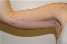 Arm Lift After Photo by Steve Laverson, MD, FACS; San Diego, CA - Case 37558