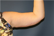 Arm Lift After Photo by Steve Laverson, MD, FACS; San Diego, CA - Case 37560