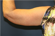 Arm Lift After Photo by Steve Laverson, MD, FACS; San Diego, CA - Case 37560