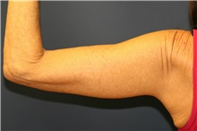Arm Lift After Photo by Steve Laverson, MD, FACS; San Diego, CA - Case 37728