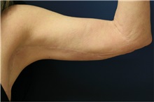 Arm Lift After Photo by Steve Laverson, MD, FACS; San Diego, CA - Case 37741