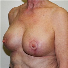 Breast Reduction After Photo by Steve Laverson, MD, FACS; Rancho Santa Fe, CA - Case 37742
