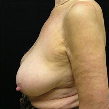 Breast Reduction Before Photo by Steve Laverson, MD, FACS; Rancho Santa Fe, CA - Case 37742