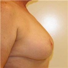 Breast Reduction After Photo by Steve Laverson, MD, FACS; Rancho Santa Fe, CA - Case 37746