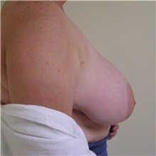 Breast Reduction Before Photo by Steve Laverson, MD, FACS; Rancho Santa Fe, CA - Case 37746