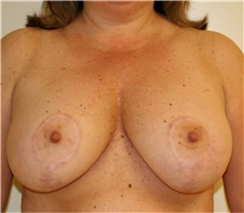 Breast Reduction After Photo by Steve Laverson, MD; San Diego, CA - Case 37748