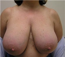 Breast Reduction Before Photo by Steve Laverson, MD; San Diego, CA - Case 37748