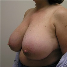 Breast Reduction Before Photo by Steve Laverson, MD, FACS; Rancho Santa Fe, CA - Case 37748