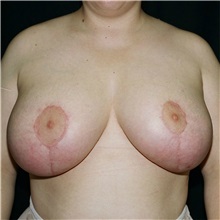 Breast Reduction After Photo by Steve Laverson, MD, FACS; Rancho Santa Fe, CA - Case 37869