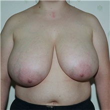Breast Reduction Before Photo by Steve Laverson, MD, FACS; Rancho Santa Fe, CA - Case 37869