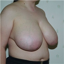 Breast Reduction Before Photo by Steve Laverson, MD, FACS; Rancho Santa Fe, CA - Case 37869