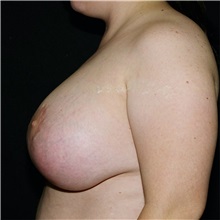 Breast Reduction After Photo by Steve Laverson, MD, FACS; Rancho Santa Fe, CA - Case 37869