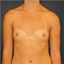 Breast Augmentation Before Photo by Steve Laverson, MD, FACS; Rancho Santa Fe, CA - Case 37889