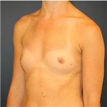 Breast Augmentation Before Photo by Steve Laverson, MD, FACS; Rancho Santa Fe, CA - Case 37889