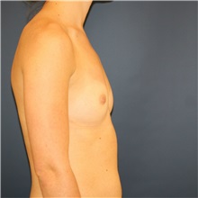 Breast Augmentation Before Photo by Steve Laverson, MD, FACS; Rancho Santa Fe, CA - Case 37889