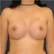 Breast Augmentation After Photo by Steve Laverson, MD, FACS; Rancho Santa Fe, CA - Case 37890