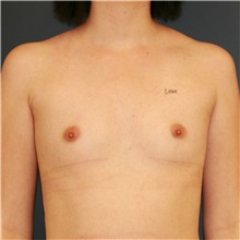 Breast Augmentation Before Photo by Steve Laverson, MD, FACS; Rancho Santa Fe, CA - Case 37890