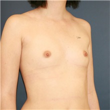 Breast Augmentation Before Photo by Steve Laverson, MD, FACS; Rancho Santa Fe, CA - Case 37890