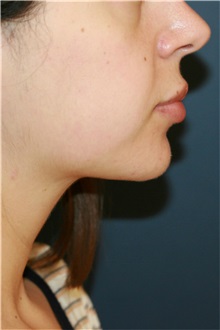 Liposuction After Photo by Steve Laverson, MD, FACS; Rancho Santa Fe, CA - Case 37899