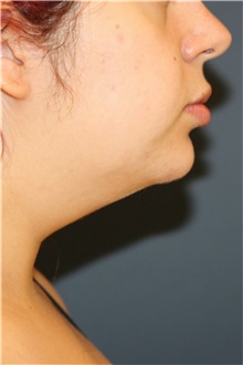 Liposuction Before Photo by Steve Laverson, MD, FACS; San Diego, CA - Case 37899