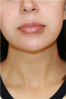 Liposuction After Photo by Steve Laverson, MD, FACS; Rancho Santa Fe, CA - Case 37899