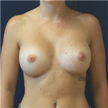 Breast Augmentation After Photo by Steve Laverson, MD; San Diego, CA - Case 37900