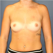Breast Augmentation Before Photo by Steve Laverson, MD; San Diego, CA - Case 37900