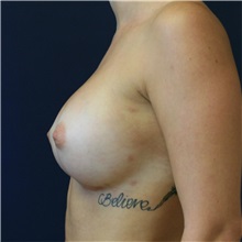 Breast Augmentation After Photo by Steve Laverson, MD, FACS; Rancho Santa Fe, CA - Case 37900