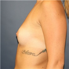 Breast Augmentation Before Photo by Steve Laverson, MD, FACS; Rancho Santa Fe, CA - Case 37900