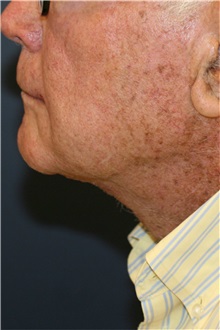 Neck Lift After Photo by Steve Laverson, MD, FACS; Rancho Santa Fe, CA - Case 37919