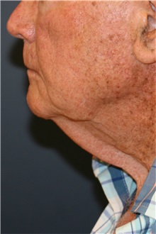 Neck Lift Before Photo by Steve Laverson, MD, FACS; Rancho Santa Fe, CA - Case 37919