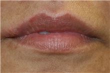 Lip Augmentation/Enhancement After Photo by Steve Laverson, MD, FACS; Rancho Santa Fe, CA - Case 37920