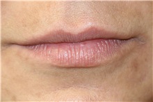 Lip Augmentation/Enhancement Before Photo by Steve Laverson, MD, FACS; Rancho Santa Fe, CA - Case 37920
