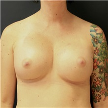 Breast Augmentation After Photo by Steve Laverson, MD, FACS; Rancho Santa Fe, CA - Case 37924
