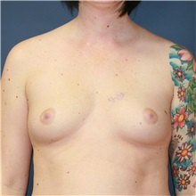 Breast Augmentation Before Photo by Steve Laverson, MD, FACS; San Diego, CA - Case 37924
