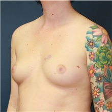 Breast Augmentation Before Photo by Steve Laverson, MD, FACS; Rancho Santa Fe, CA - Case 37924