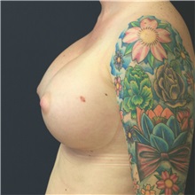 Breast Augmentation After Photo by Steve Laverson, MD, FACS; Rancho Santa Fe, CA - Case 37924