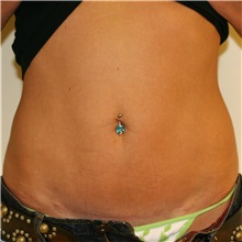 Tummy Tuck After Photo by Steve Laverson, MD, FACS; Rancho Santa Fe, CA - Case 37928