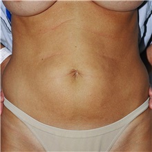 Tummy Tuck Before Photo by Steve Laverson, MD, FACS; Rancho Santa Fe, CA - Case 37928