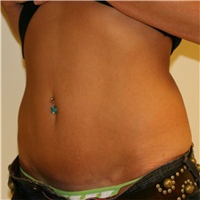 Tummy Tuck After Photo by Steve Laverson, MD, FACS; Rancho Santa Fe, CA - Case 37928