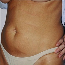 Tummy Tuck Before Photo by Steve Laverson, MD, FACS; Rancho Santa Fe, CA - Case 37928